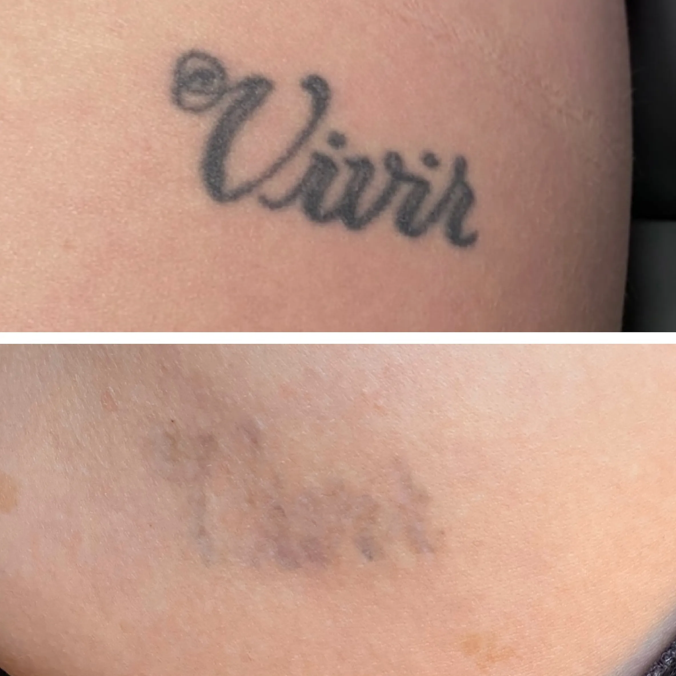 at home tattoo removal pen risks