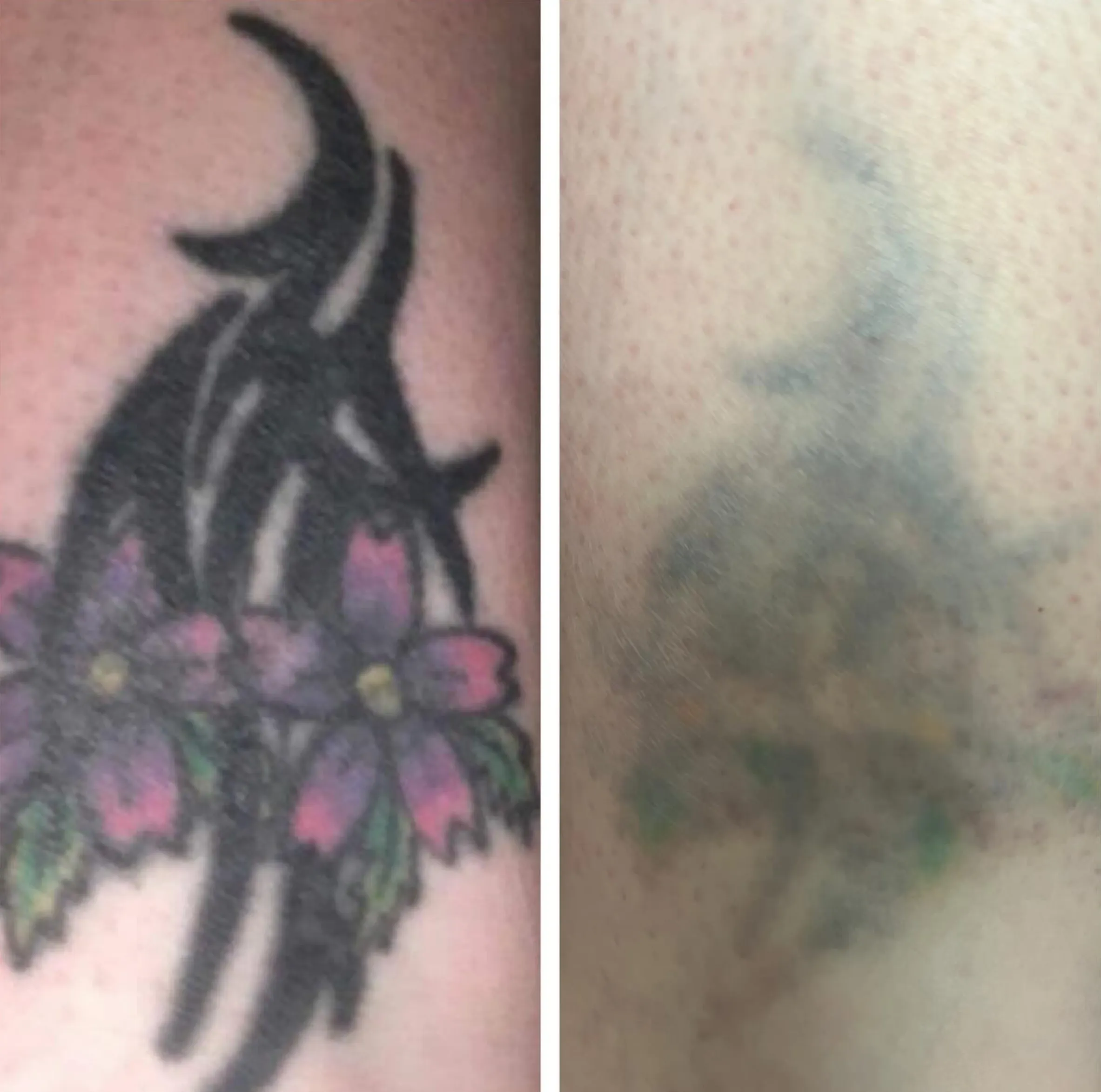 tattoo pen vs laser removal