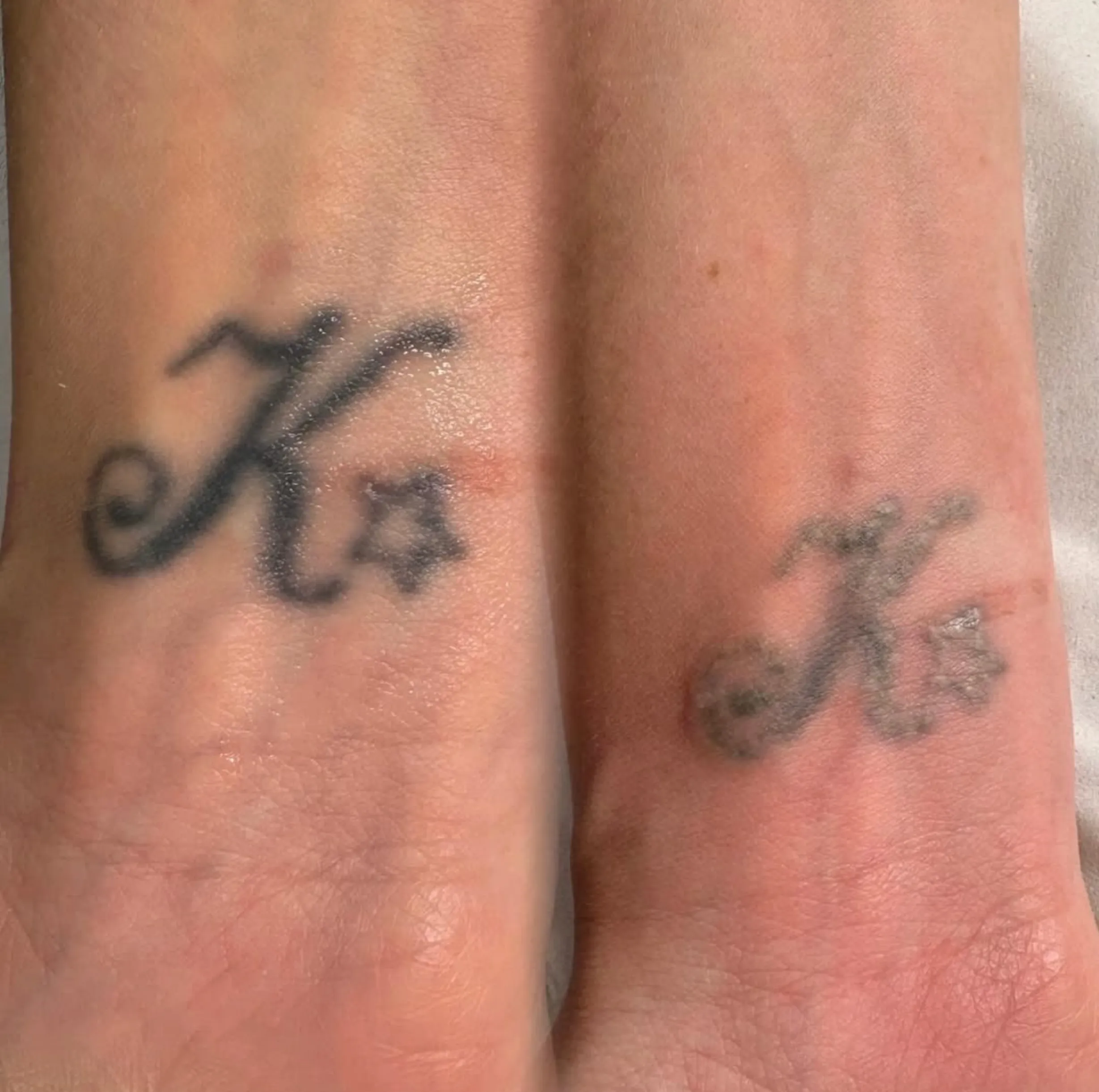 tattoo removal pen side effects