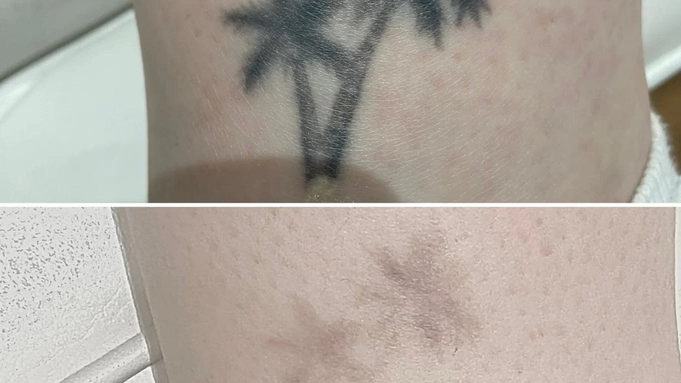 Tattoo Removal Pens