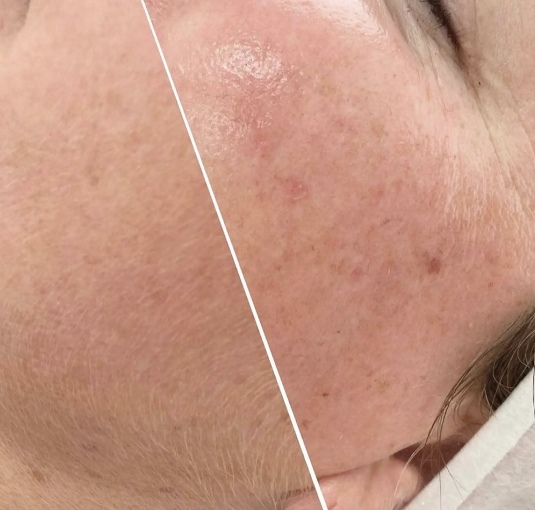 dermaplaning Brisbane