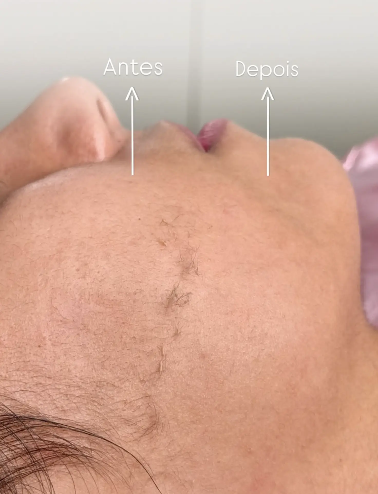 dermaplaning results timeline