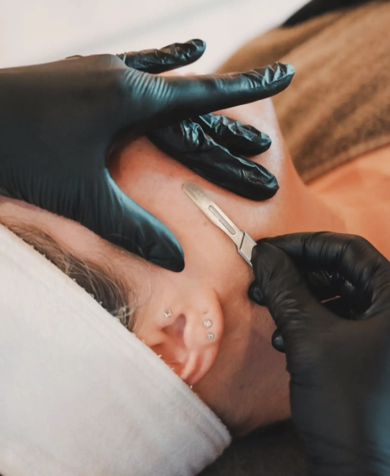 does dermaplaning remove peach fuzz