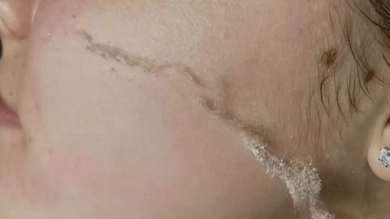 how long does dermaplaning last