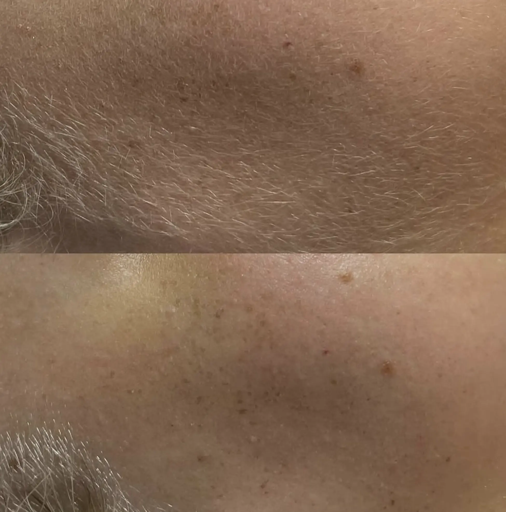 how often should I get dermaplaning