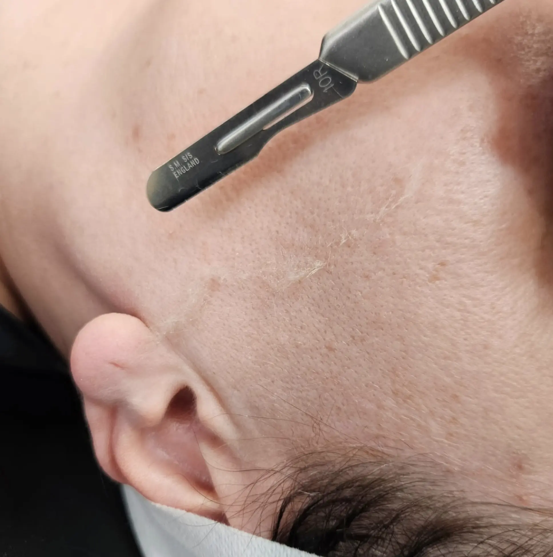 is dermaplaning safe procedure
